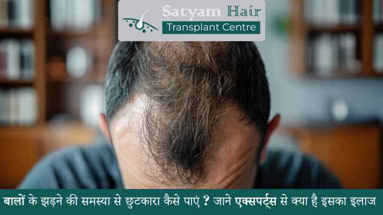 बालों के झड़ने की समस्या से छुटकारा कैसे पाएं ? जाने एक्सपर्ट्स से क्या है इसका इलाज